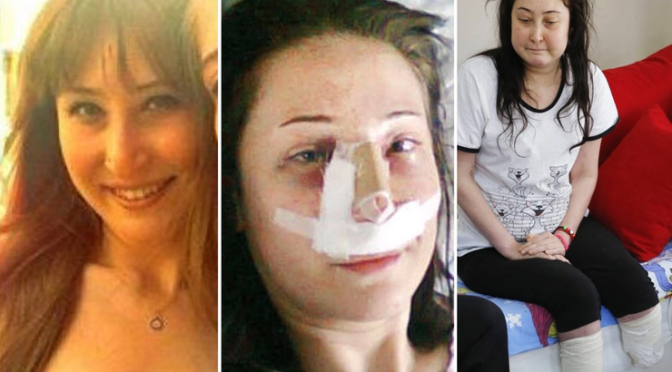 Turquie : Une jeune femme perd ses deux jambes après une chirurgie du nez !