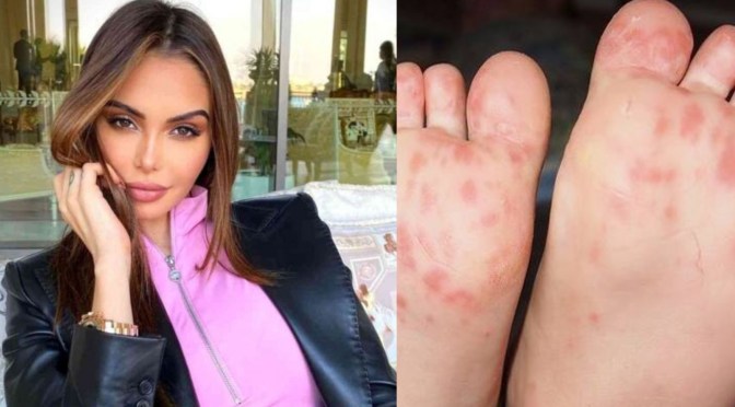 Nabilla Benattia atteinte de la maladie pieds-mains-bouche.