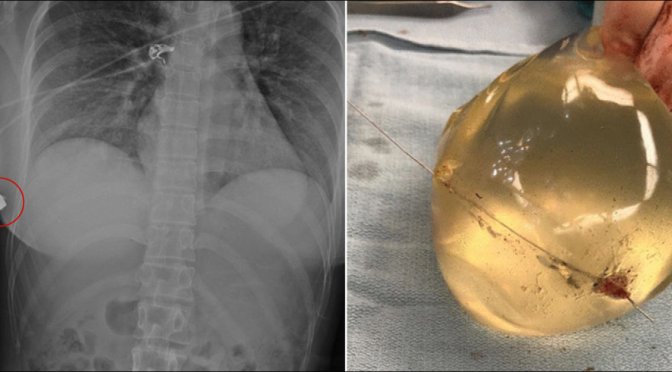 Canada : Elle survit à une balle reçue à bout portant grâce à ses implants mammaires.