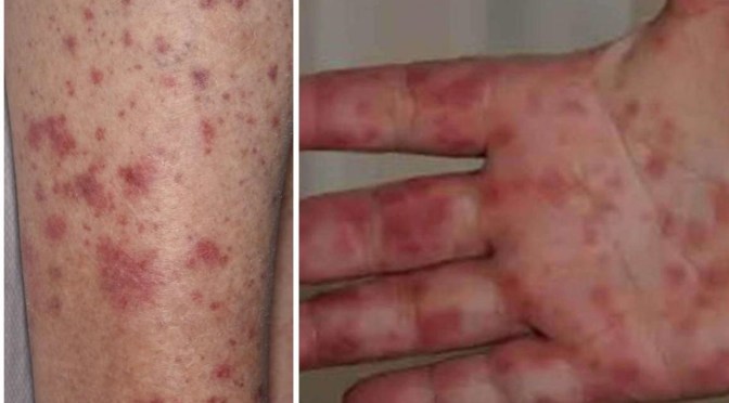 Grippe de la tomate : quel est ce nouveau virus détecté en Inde ?