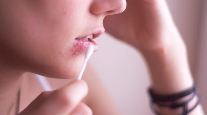 Le mystère de l’origine du virus de l’herpès facial enfin dévoilée !