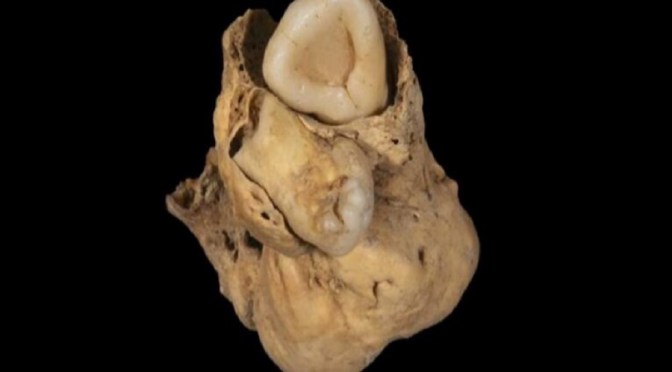 Archéologie : Une tumeur ovarienne constituée de dents découverte dans une tombe de l&rsquo;Égypte antique